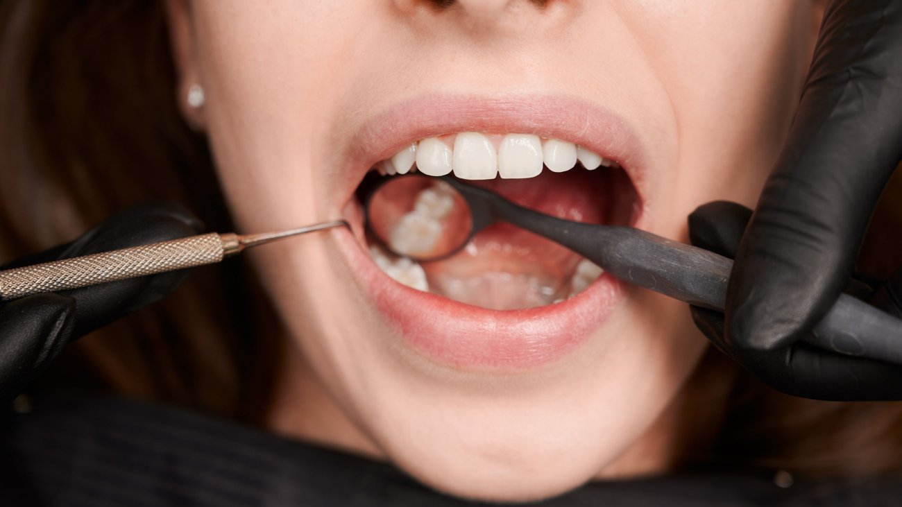 Early Tooth Decay Signs