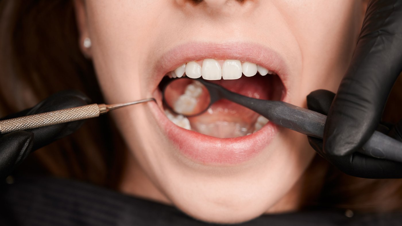 Early Tooth Decay Signs