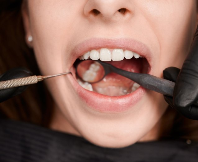 Early Tooth Decay Signs